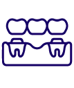 Dental Bridges