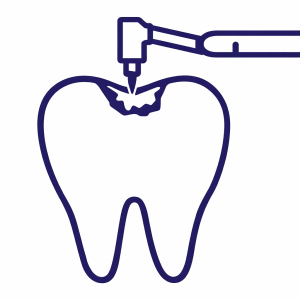 White Tooth Fillings