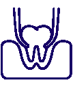 Wisdom Teeth and Dental Extractions