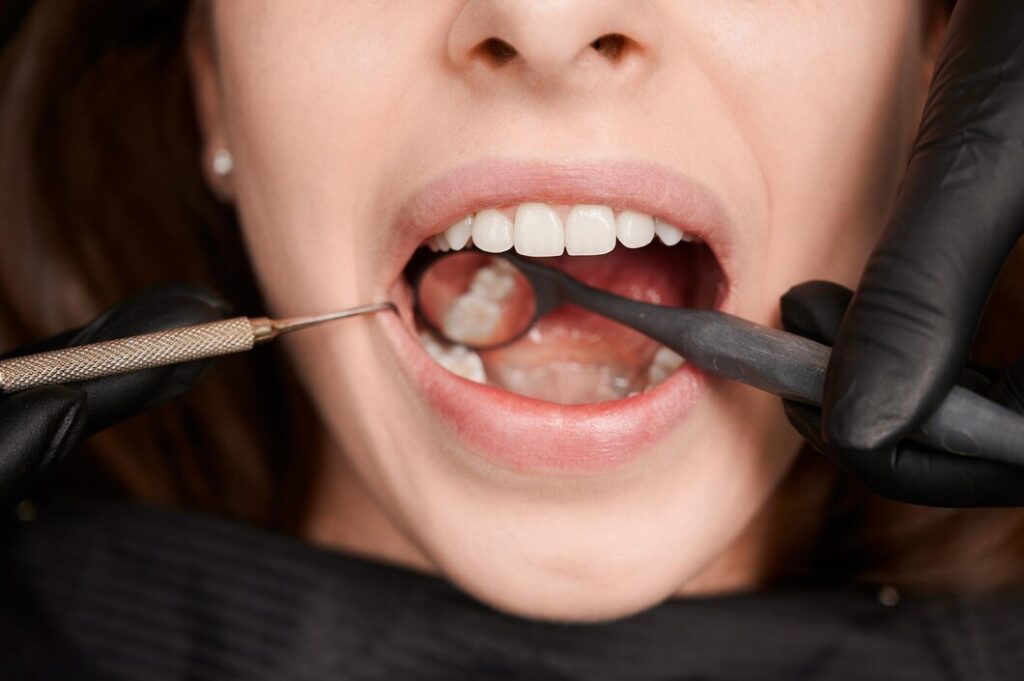 Crooked Teeth – What’s The Perfect Treatment for You?